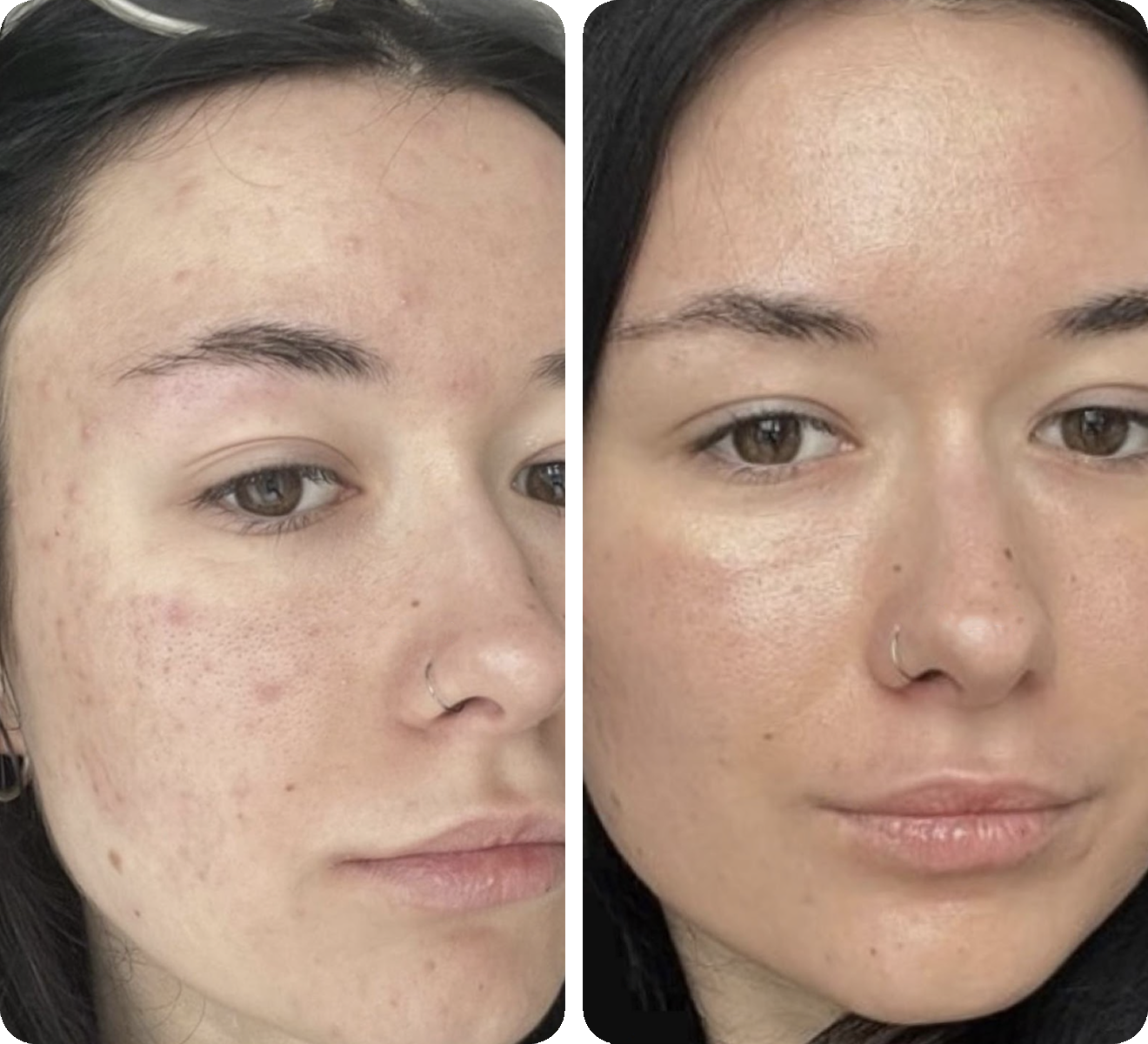 Neogen before and after comparison, example 2