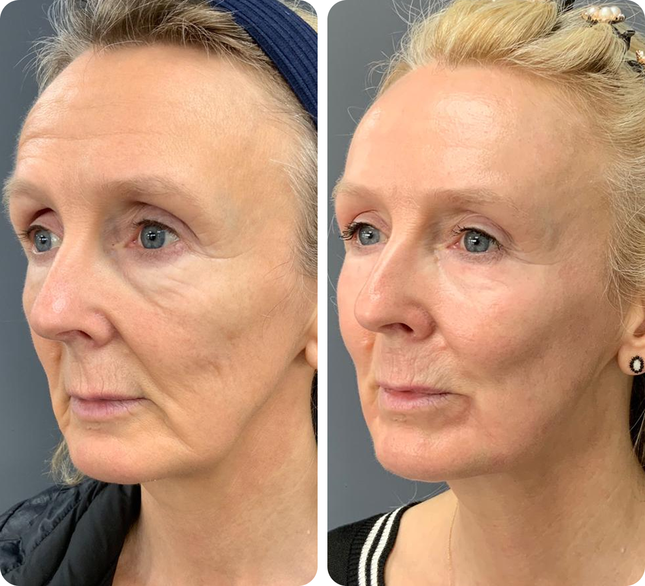 Neogen before and after comparison, example 1