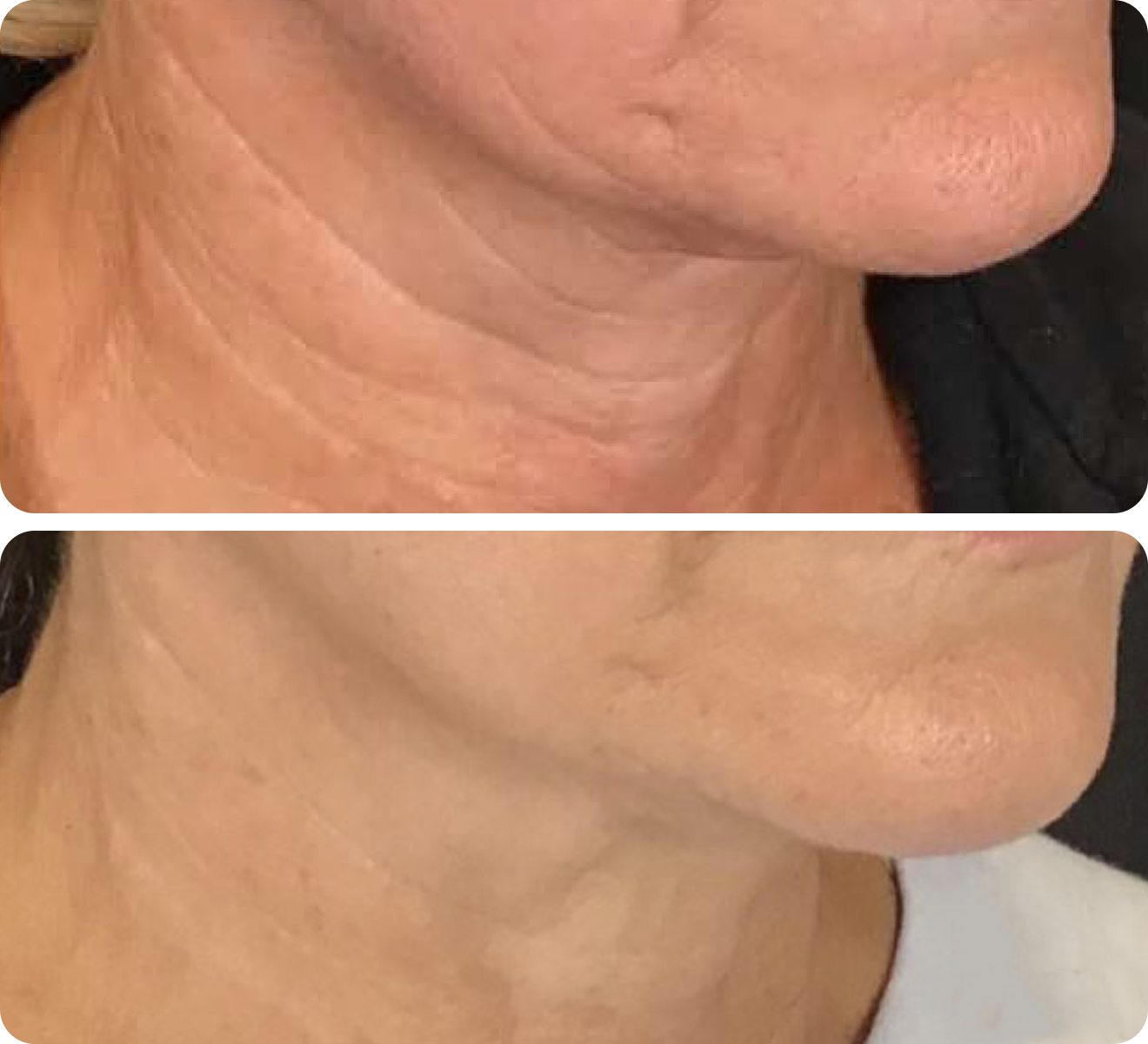 Neogen before and after comparison, example 3