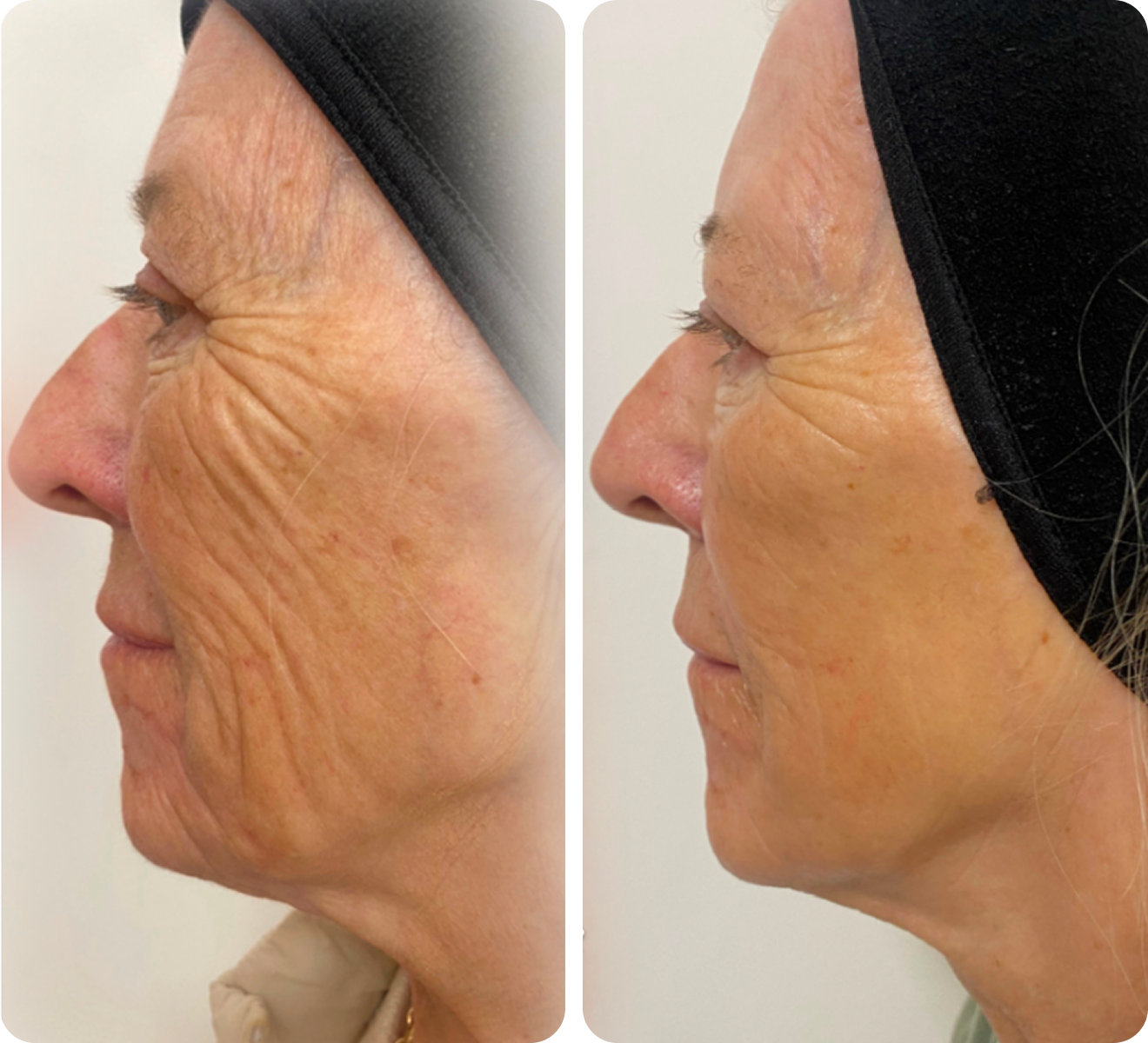 Neogen before and after comparison, example 4